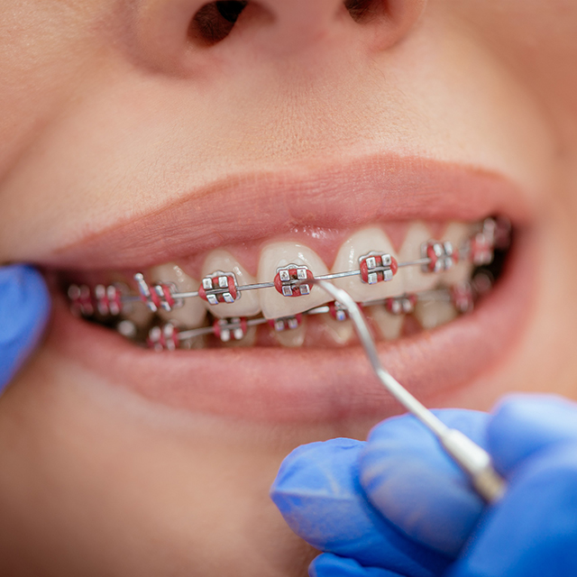 ortodontie - Paris Dental Clinic, stomatologie Cluj, dental clinic Cluj