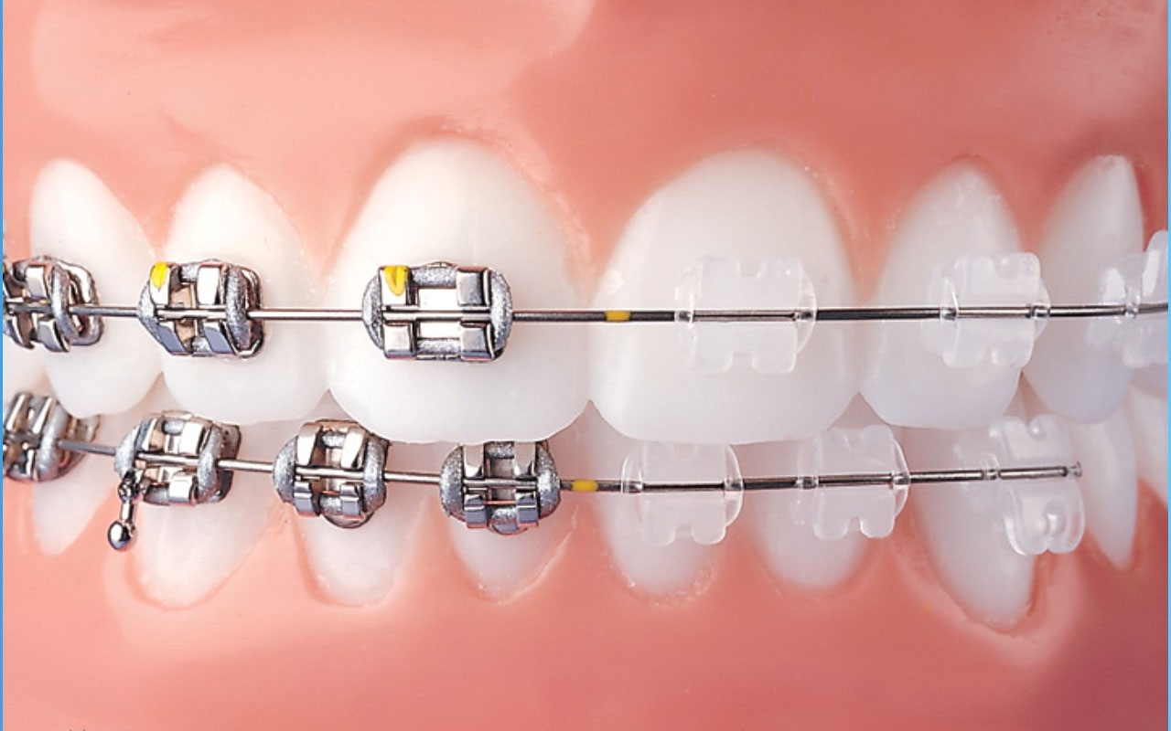 aparate dentasre ortodontice fixe