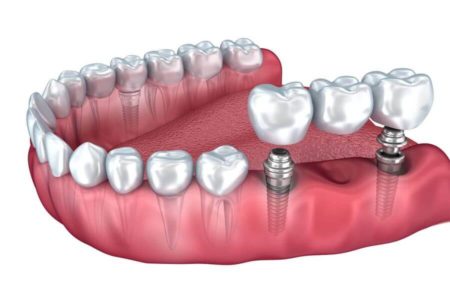 etape implant dentar Paris Dental