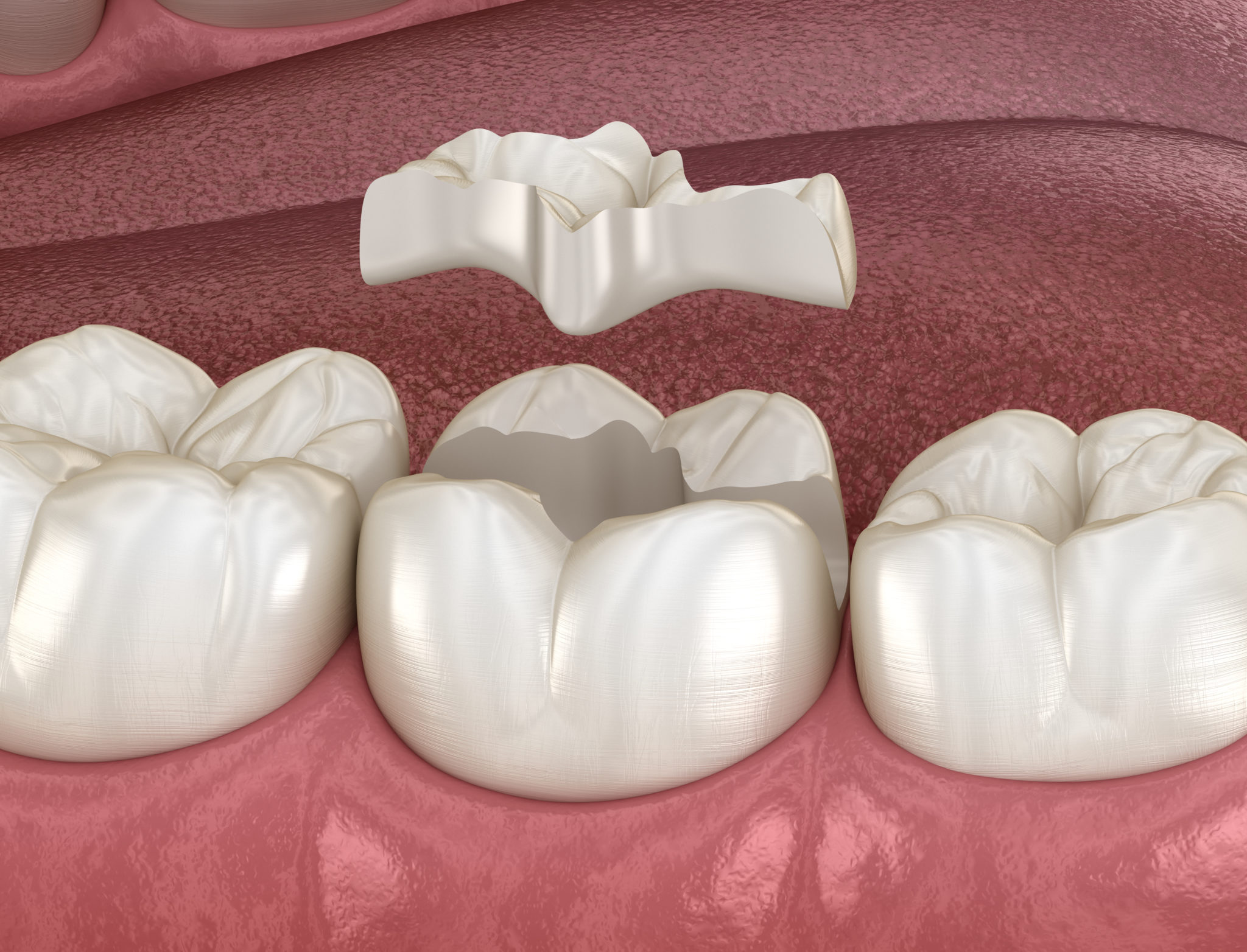 Inlay Compozit inlay / onlay compozit Archives - Paris Dental Clinic