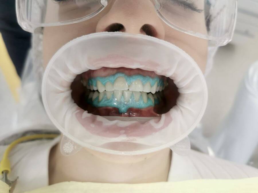 albire dentara profesionala cu laser EpicX de la Biolase