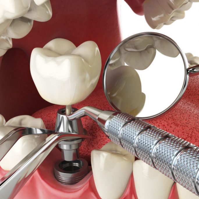 implantologie - Paris Dental Clinic, stomatologie Cluj, dental clinic Cluj