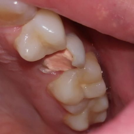 Paris Dental Clinic Cluj - tratamente endodontice